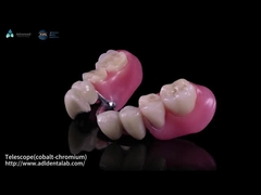 Telescópio Co-Cr interno e Co-Cr externo de metal parcial com compósito