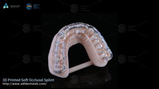 Tala impressa em 3D personalizada para conforto de bruxismo