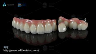 Coroas dentárias PFZ com resistência natural e ajuste preciso