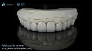 Folheados cerâmicos feldspáticos de alta translucidez para sorrisos