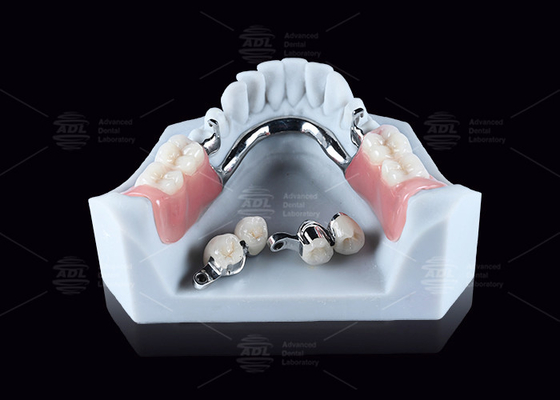 comprar CEKA M2 fixação de precisão de titânio com 3 mm de espaçamento horizontal / vertical Fabricação em linha