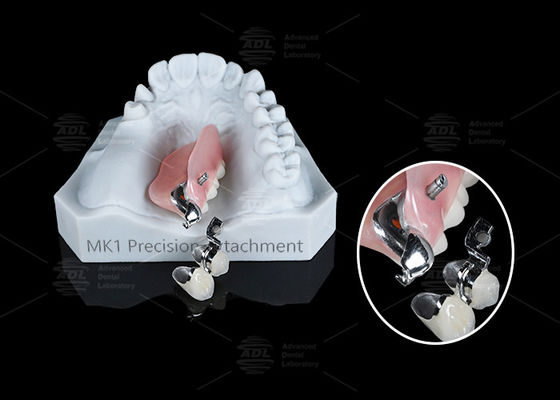 comprar MK1 Anexo Prótese Dental Prata Dentadura Parcial Anexos de Precisão Fabricação em linha