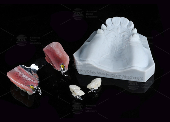comprar Prótese Dental Caminho-chave Ligação Precisão Ligação Força de retenção ajustável Fabricação em linha