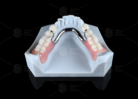 comprar Acessórios de precisão ERA multifuncionais ajustáveis Acessórios ERA removíveis para dentaduras Fabricação em linha