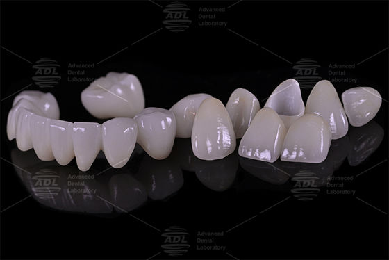 comprar Porcelana de laboratório dentário da China fundida com zircônio de alta resistência fornecendo serviços personalizados para laboratório dentário e dentista internacional Fabricação em linha