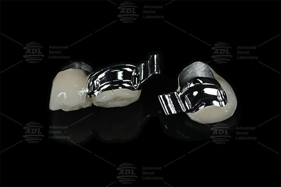 comprar China Laboratório Dentário ajustável do paciente específico Keyway Precision Attachment com PFM Fabricação em linha