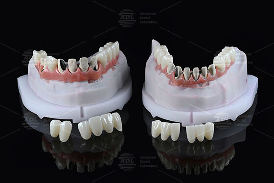 comprar China Dental Lab Titânio Full Arch Hybrid Bridge com Carregamento Imediato A1 Shade Malong Design Screw Retained Cad/Cam Fabricação em linha