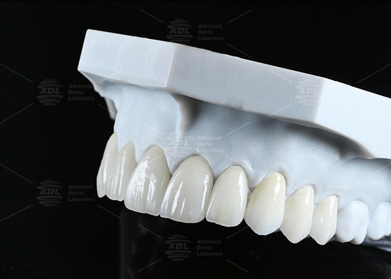 Translucidez CAD EMAX Veneer Polidas Cerâmicas Vidradas Restaurações Para Áreas Anteriores Posteriores