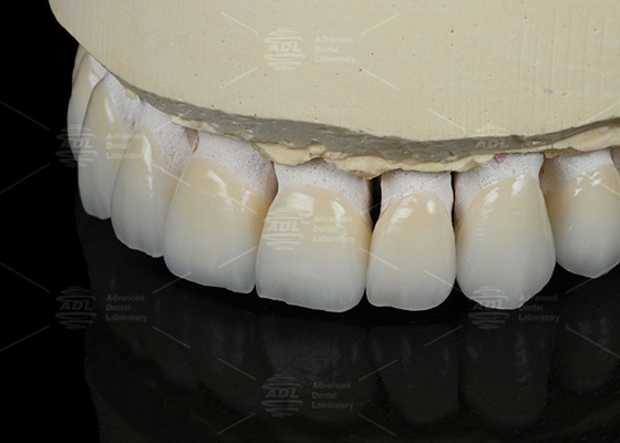 Coloração natural do dente Finê de cerâmica feldspática para dentes anteriores e posteriores