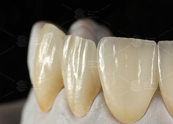 0.3mm-0.7mm Filtro Espático Filtro Cerâmico EMAX Filtro Dental Emax
