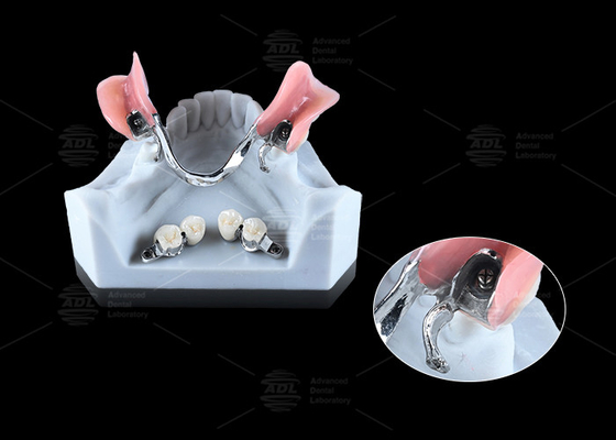 0.1mm Tolerância CEKA REVAX Anexo Titânio 3mm
