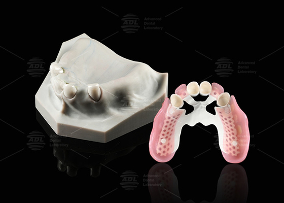 Biocompatibilidade Telescópio Dental Branco Circônio Interno Telescópio Dental