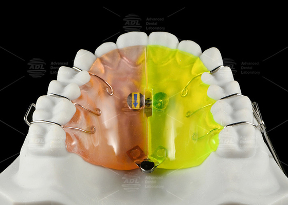 Expansor ortodôntico em forma de ventoinha proporciona expansão de secção posterior livre de crosbite