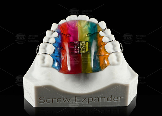 Expansão e Distalização dos Dentes Expansor de Palato Expansor Ortodôntico