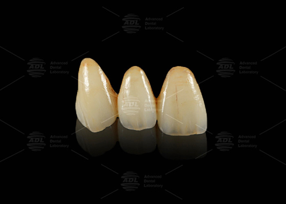 Ponte Dental EMAX Hipoalergênico Durável