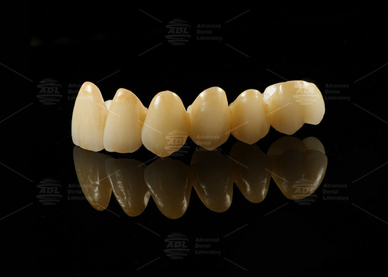 Porcelana estética forte fundida com zircônio para restaurações de aparência natural
