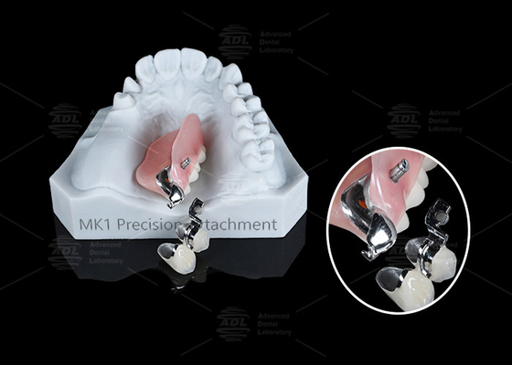 MK1 Anexo Prótese Dental Prata Dentadura Parcial Anexos de Precisão