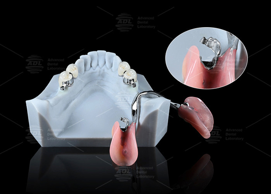 Aplicações dentárias ERA de precisão elegante para próteses dentárias seguras universais