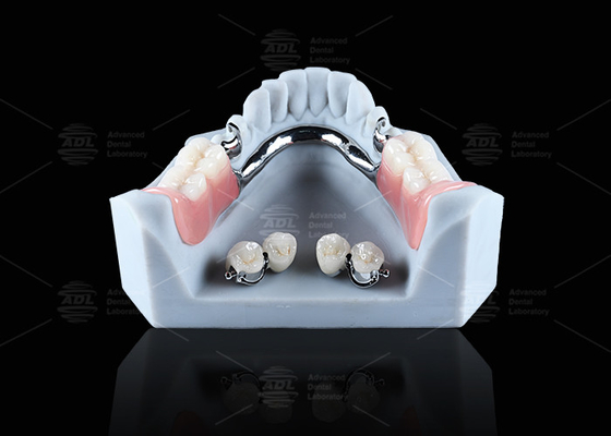 Implante dentário de titânio inserções de bola confortável segura retenção dentária