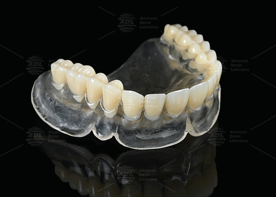 Dentaduras térmicas de curado térmico Vertex para usuários de dentaduras completas claras
