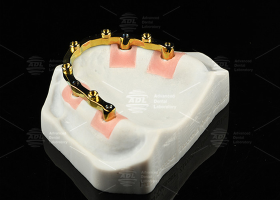Barras de localizador de implantes dentários de titânio em areia de prata de ouro
