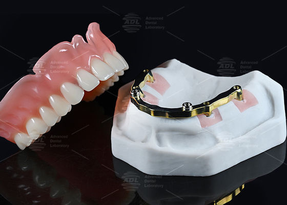 China Dental Lab Titânio Localizador Anexo com acrílico completo sobre a prótese