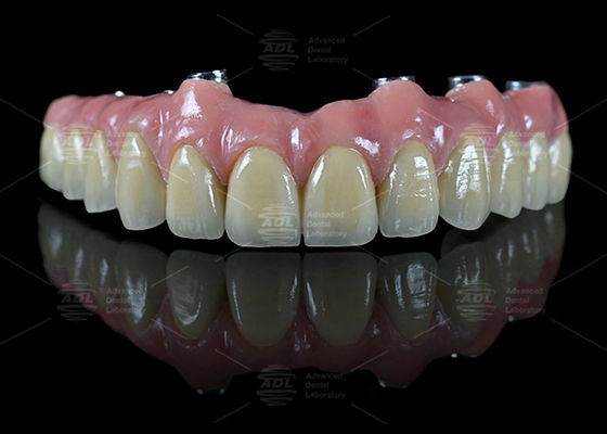 Implante de ponte híbrida Bar Malong Design parafuso retido ou cementado Método de instalação para aplicações dentárias de precisão