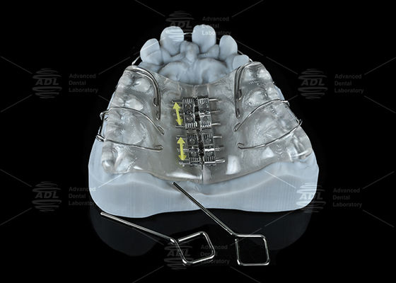 Laboratório Dental da China Expandor de parafuso de aço inoxidável colorido para expansão da maxila e da mandíbula