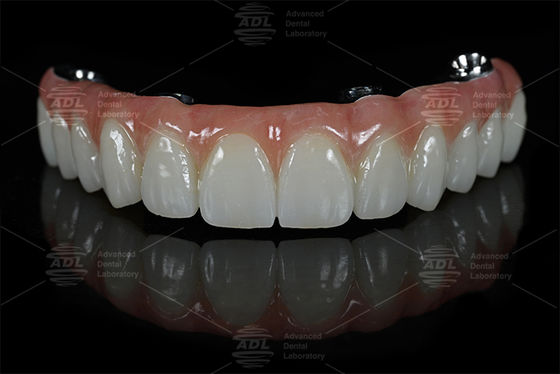 China Dental Lab Fast Turnaround Time In 72 Hours Provides High Quality All on X