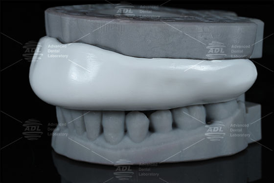 Conveniente Occlusal Splint Sport Guard Bite Splint Design fácil de limpar Confortável Dispositivo de proteção para ranger os dentes