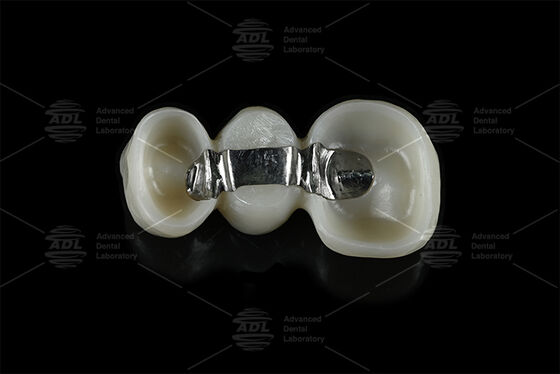 Barra de titânio de reforço personalizável combinada com zircônio moído fornecendo soluções de estrutura de implantes dentários