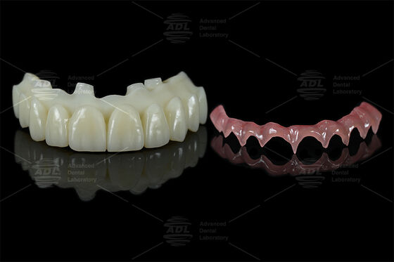 Barras de suporte de implantes impressos em 3D retidos por parafuso para tentar fixá-los diretamente em todos os laboratórios dentários chineses.