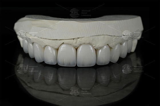 0.3mm-0.7mm Filtro Espático Filtro Cerâmico EMAX Filtro Dental Emax